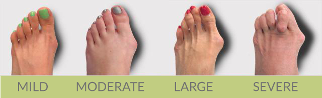 severe bunions