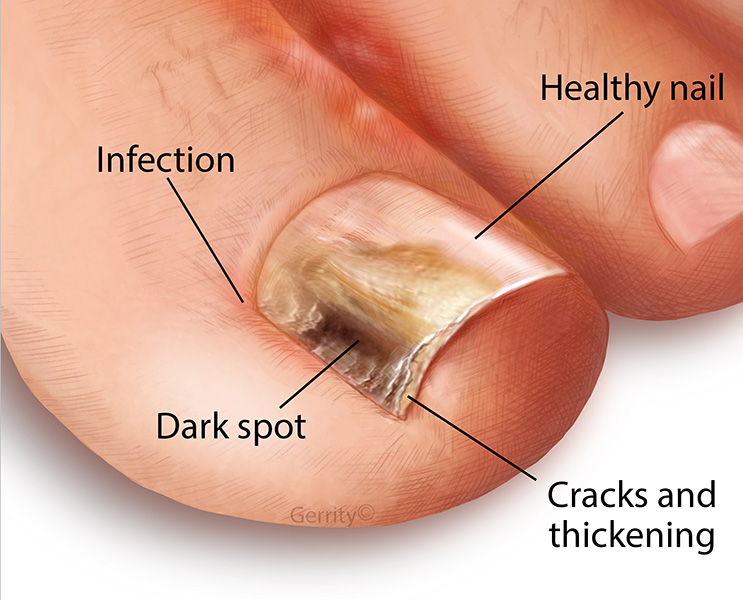 Under toenail spot black Black Spot